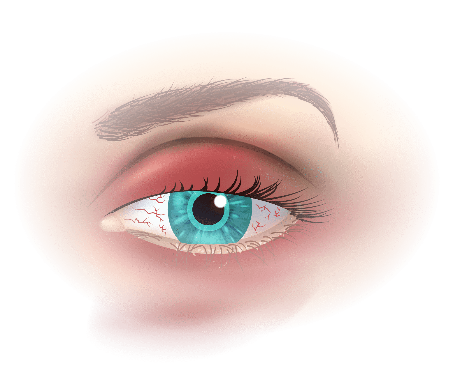 Diagnóstico 2 analyse clinique secheresse oculaire